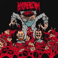 Hemispherectomy
